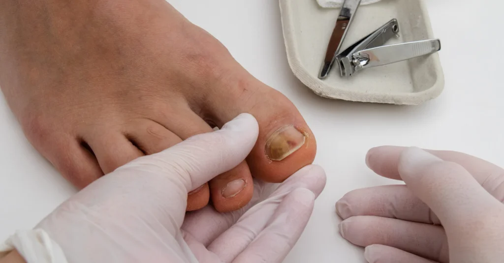 nail treatment